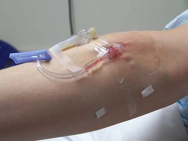 How To Start An IV
